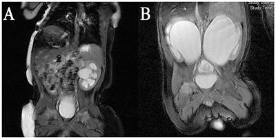 Early Robotic-Assisted Laparoscopic Pyeloplasty for Infants Under 3 Months With Severe Ureteropelvic Junction Obstruction